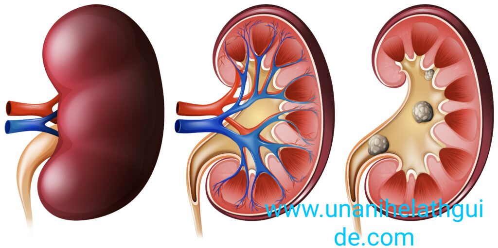 Nimbu-Pani-k-Fayde-for-kidney-stone-scaled